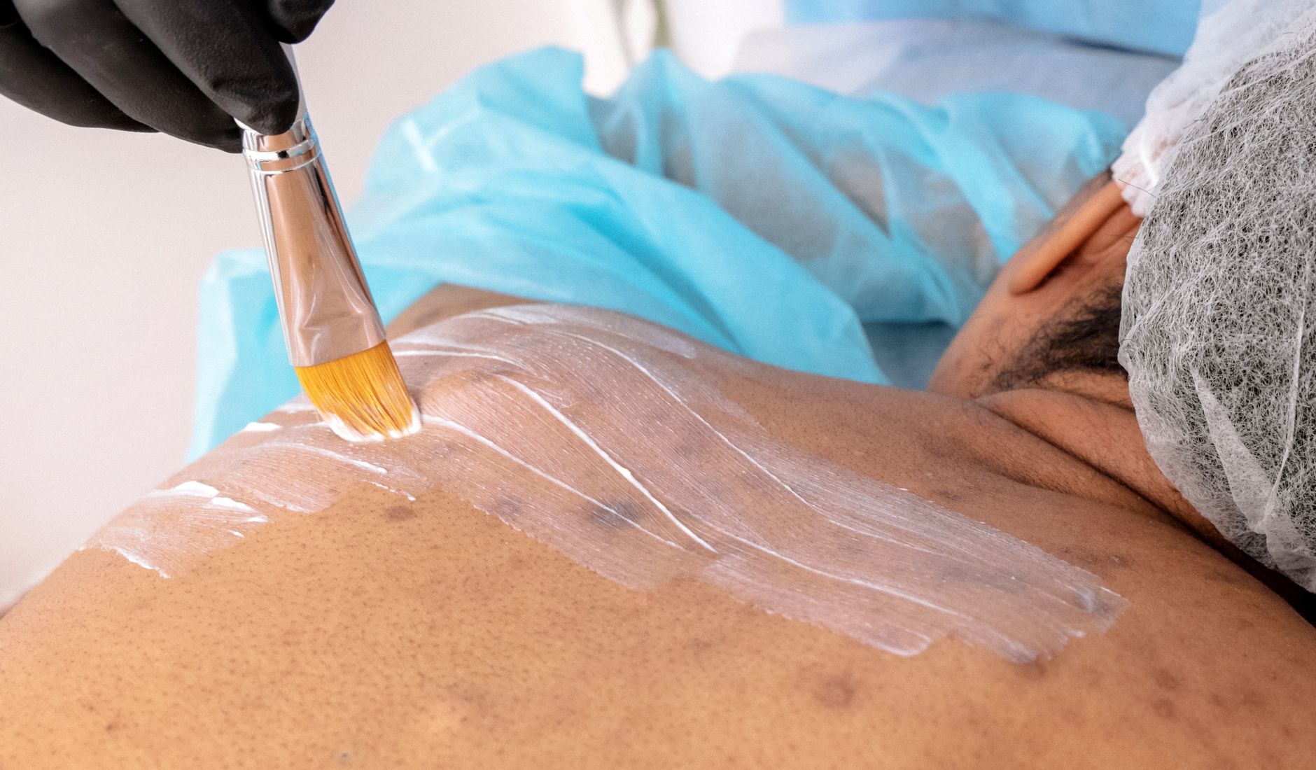 The Rise of Penis Fillers: A Cosmetic Craze or a Cause for Concern?