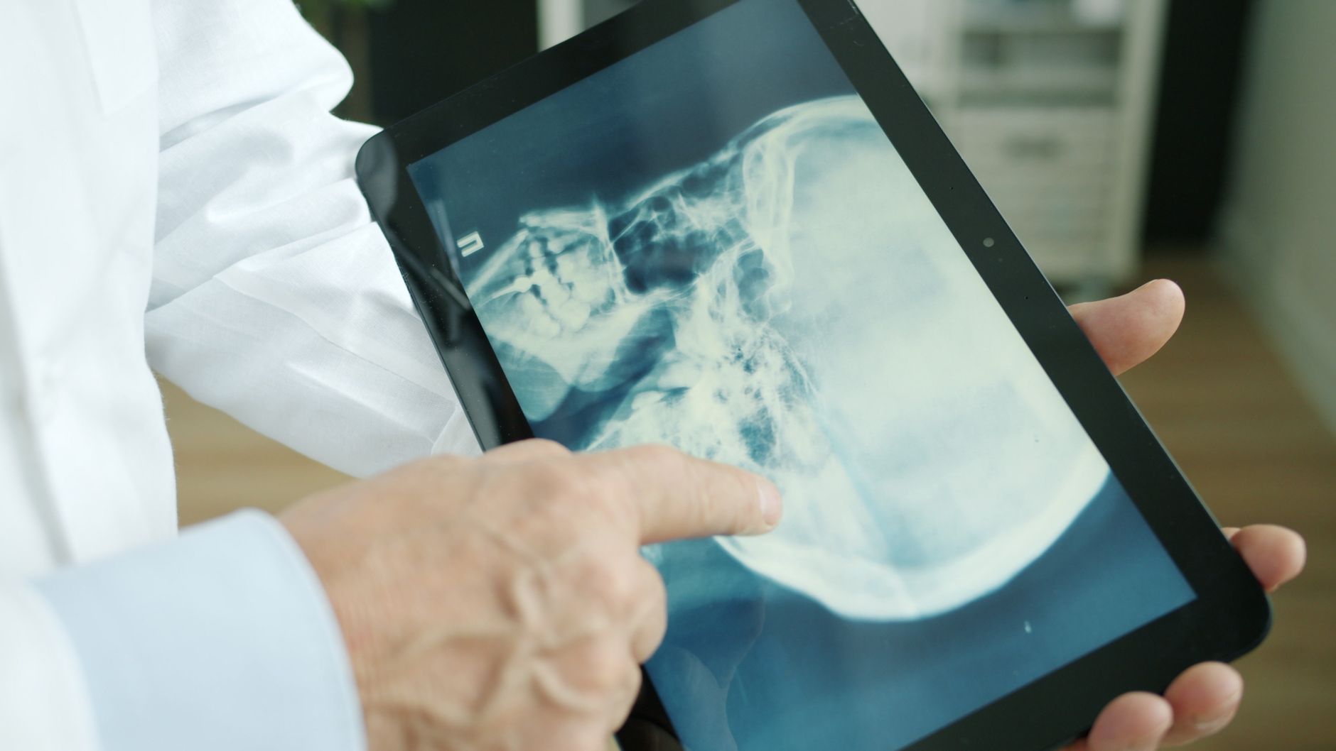 Rising Concern: Young Adults Face Early Onset of Osteoporosis