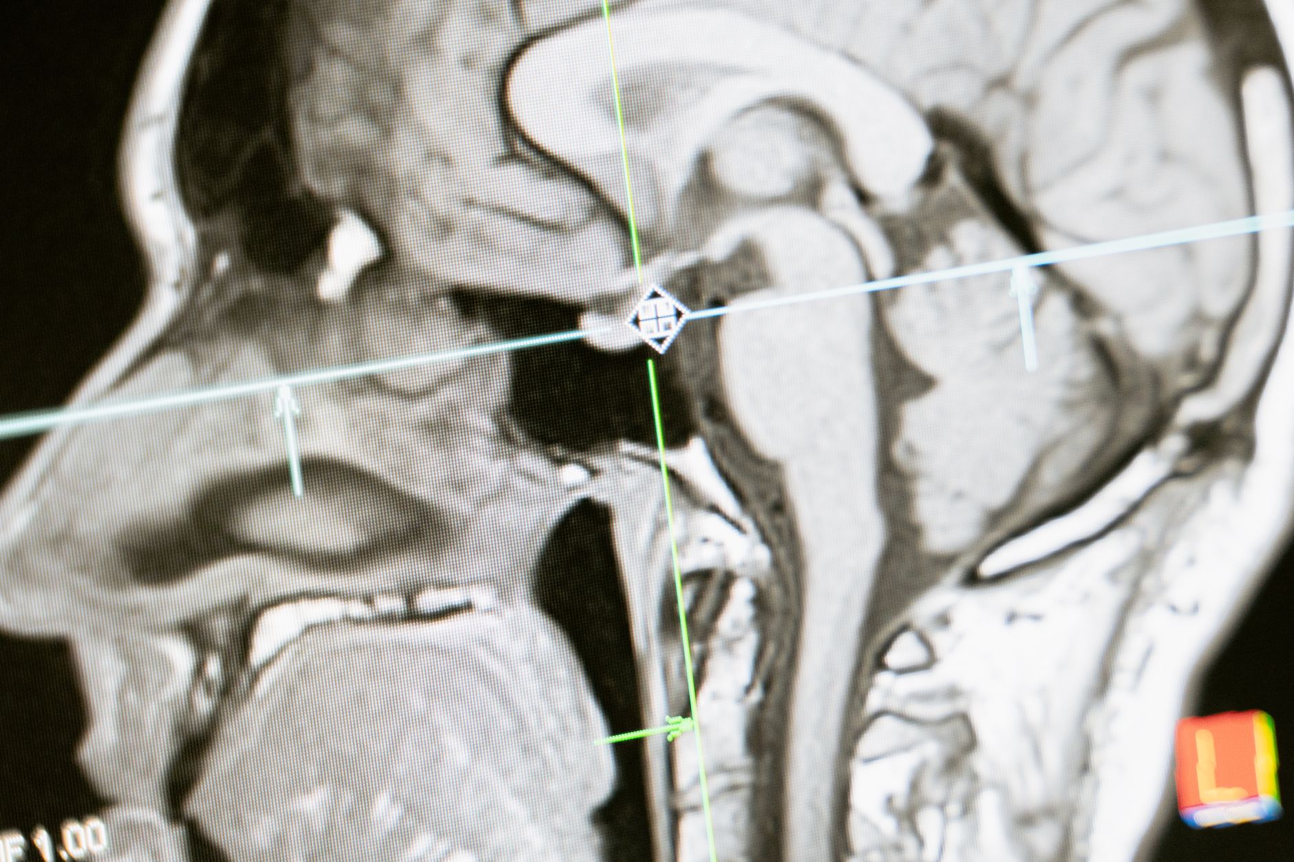 Unravelling the Mysteries of General Anaesthesia and the Human Brain