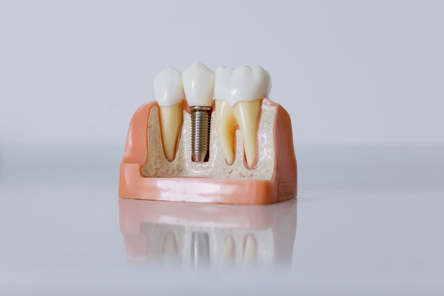 How Dental Implants Might Be Sabotaging Your Immune System